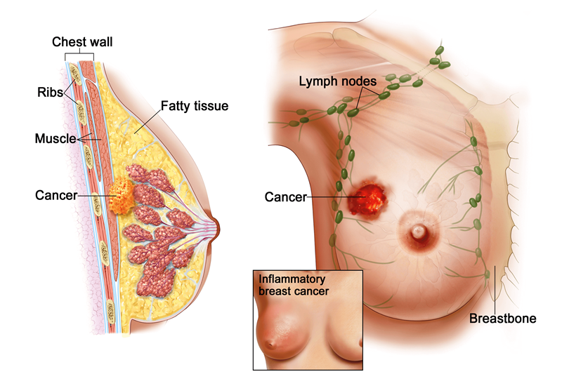 Bệnh ung thư vú là gì?